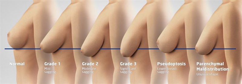 Artist's depiction of the breast ptosis grading system proposed by